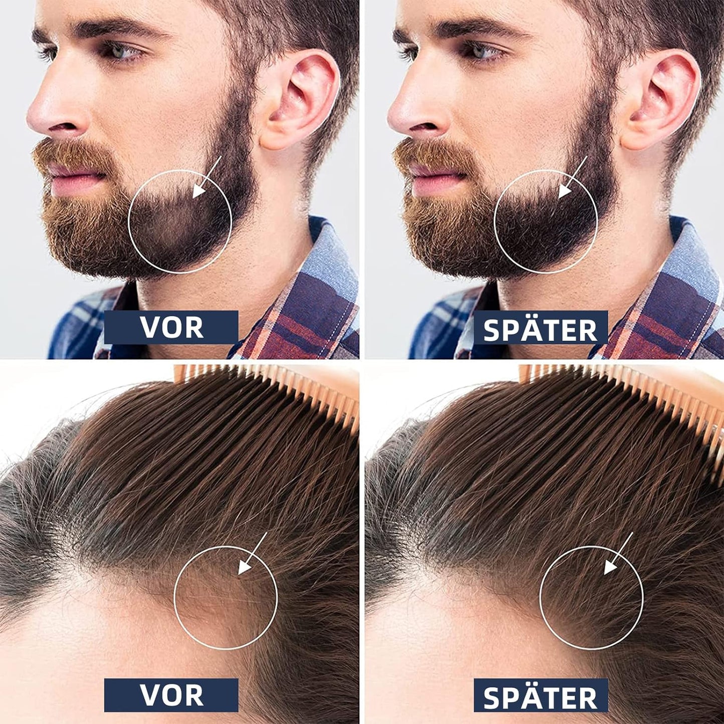 Beard Roller 0.5 mm, Derma Roller, Beard Roller, Beard Growth, Micro Needle Roller for Skin and Hair Care for Men and Women